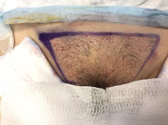 implante de pelos