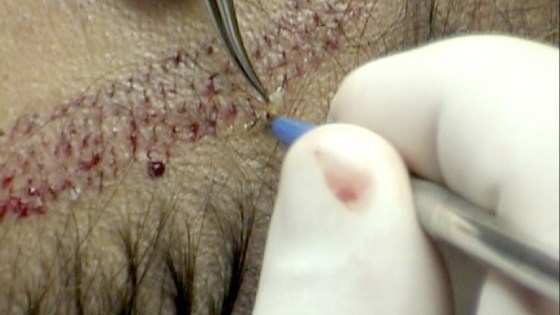 implante de pelos