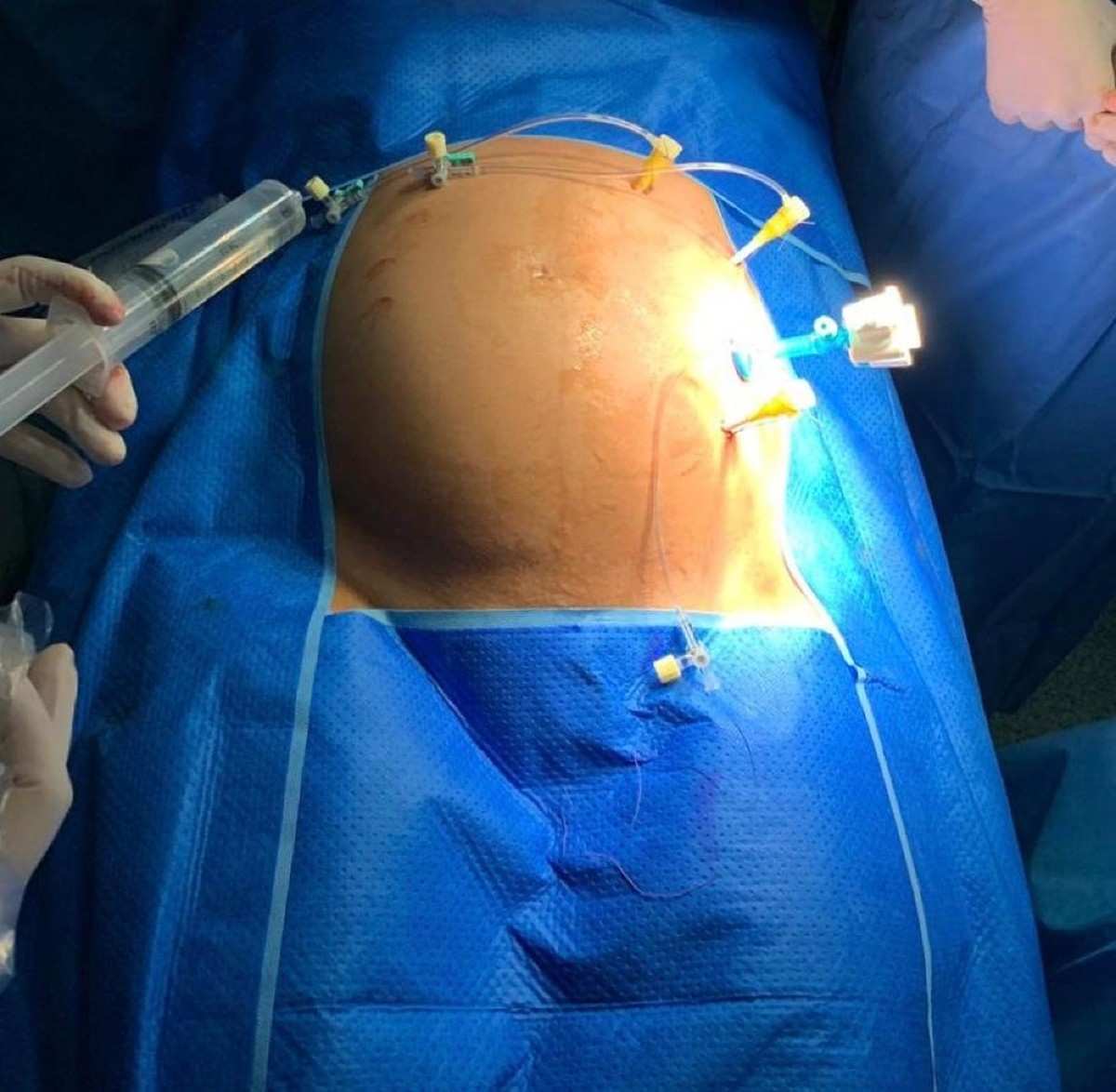 Cirurgia em feto dentro da barriga 