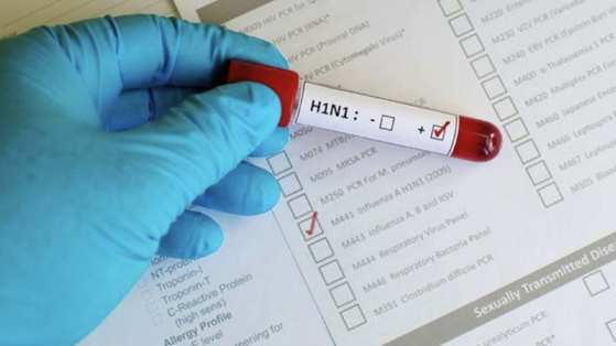 Exame gripe influenza H1N1