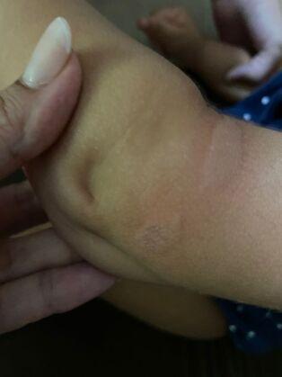 Queimadura besouro pat&oacute;