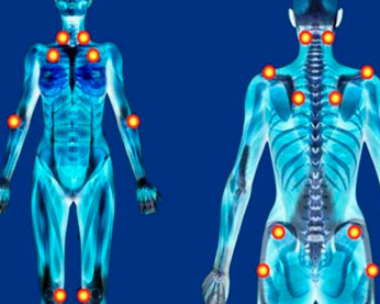FIBROMIALGIA