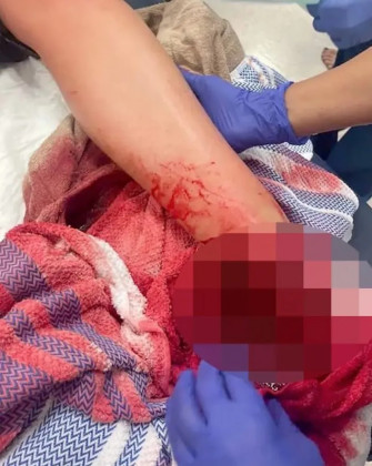TURISTA PERDE O PÉ COM MORDIDA DE TUBARÃO