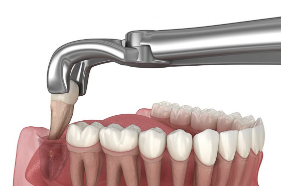 DENTE SISO