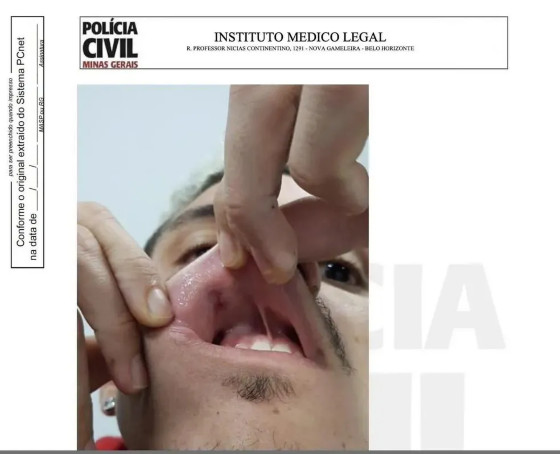 ferimento boca de pedro