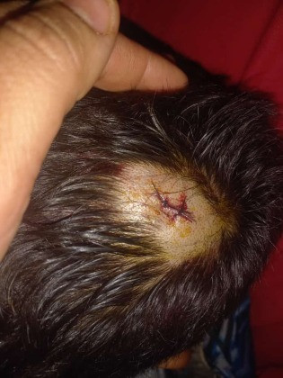 Criança com corte na cabeça 