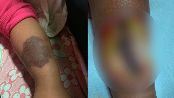 Criança perde parte do braça em Sinop