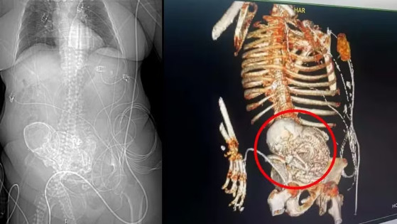 Idosa morreu após descobrir bebê calcificado em abdômen