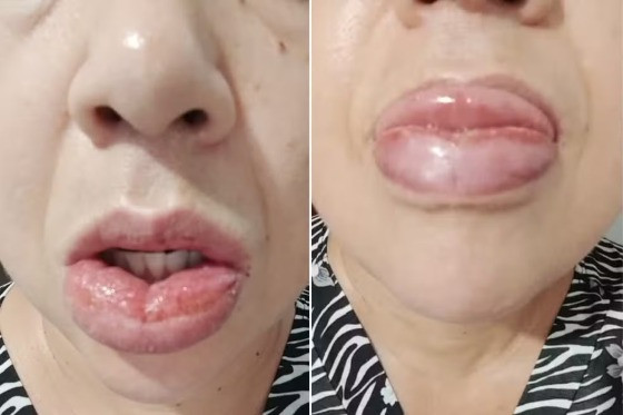 REAÇÃO ALERGICA PASTA COLGATE.jpg