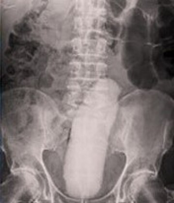 cirurgia anus 