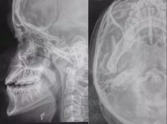 ADOLESCENTE NARIZ E DENTES QUEBRADOS.jpg