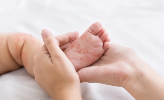 FOTO PE BEBE COM SARAMPO.jpg