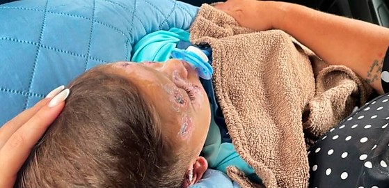 O bebê Enrico da Silva, de 3 anos, sofreu queimaduras em acidente doméstico. 