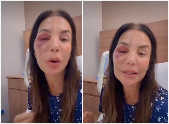 IVETE SANGALO OSSOS DO ROSTO QUEBRADOS.jpeg