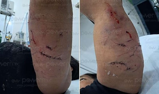 Mulher tem braço mordido por cachorro ao tentar defender pets de ataque