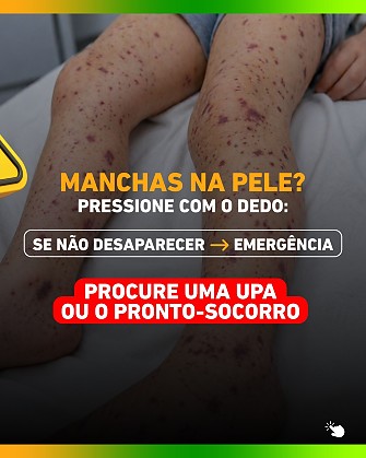 MANCHAS NA PELA MENINGITE .jpeg