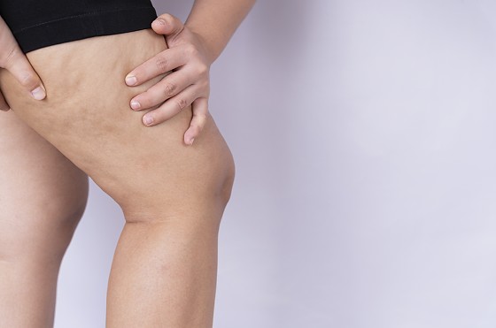 lipedema