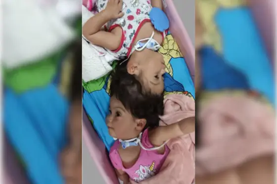 Gêmeas siamesas
