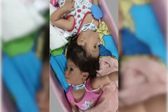 Gêmeas siamesas